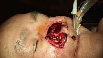 Nasal Reconstruction after vicious assault